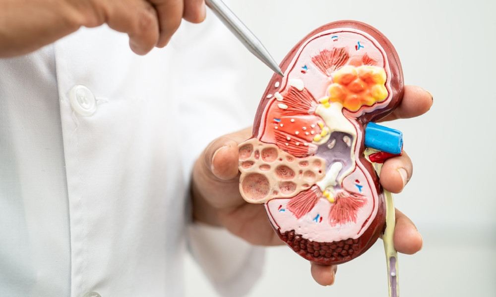 কিডনিতে পাথর কেন হয় এবং প্রতিরোধের সহজ উপায়