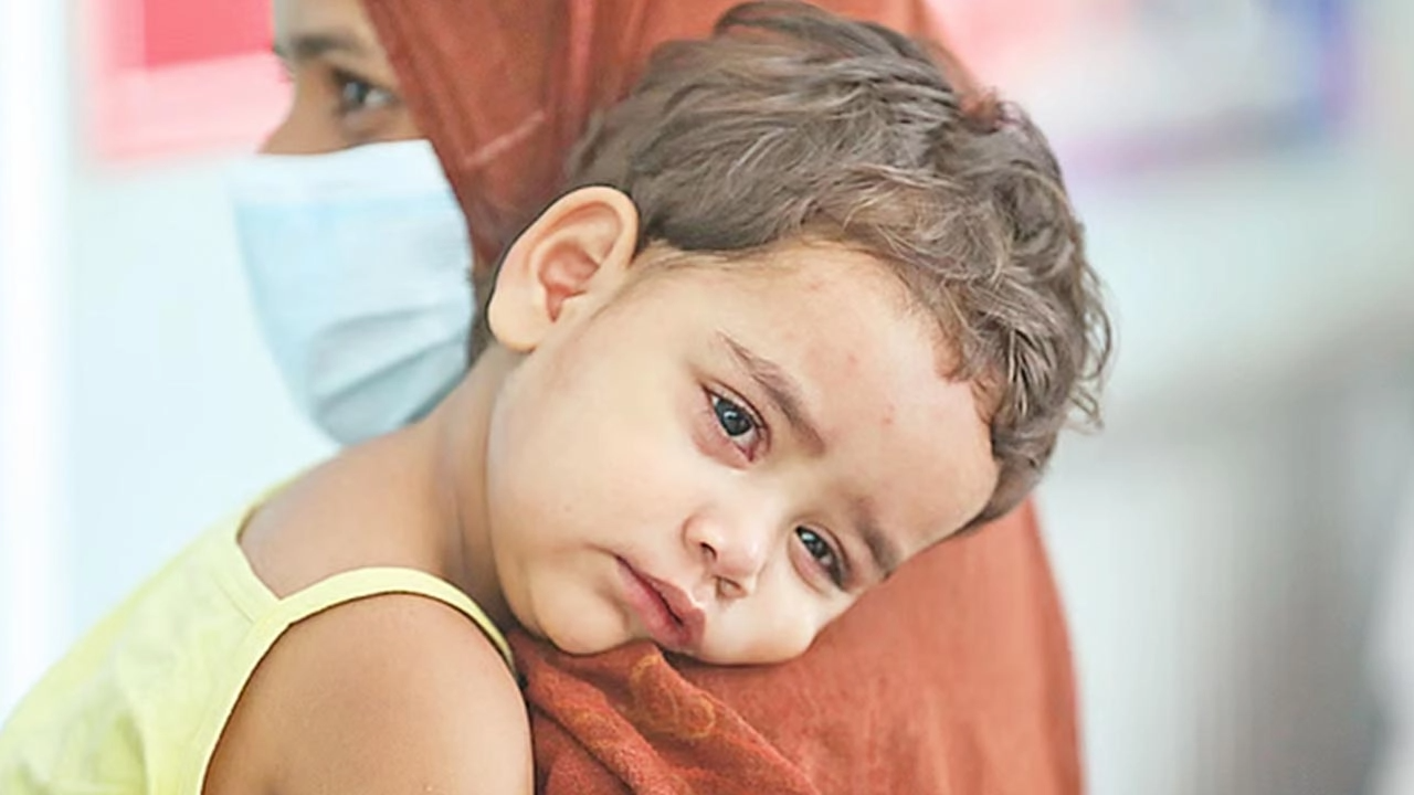 হামের ভয়াবহ বিস্তার, ২৪ ঘণ্টায় ৩ মৃত্যু ও ৯৪৭ নতুন আক্রান্ত